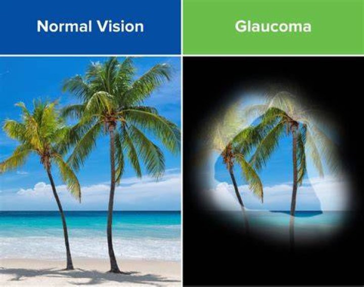 What normal vision is vs with astigmatism. Source unusualfacts6 r